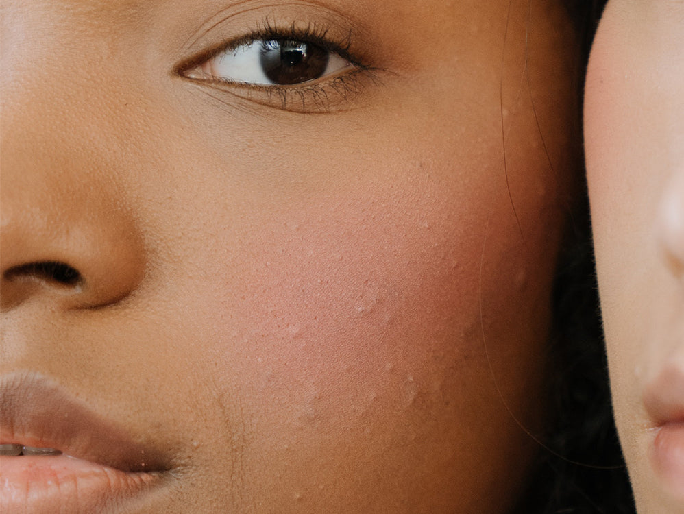 Best Acne Care Solution